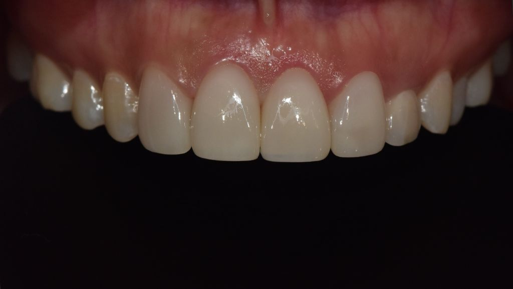 Case 03 — after treatment