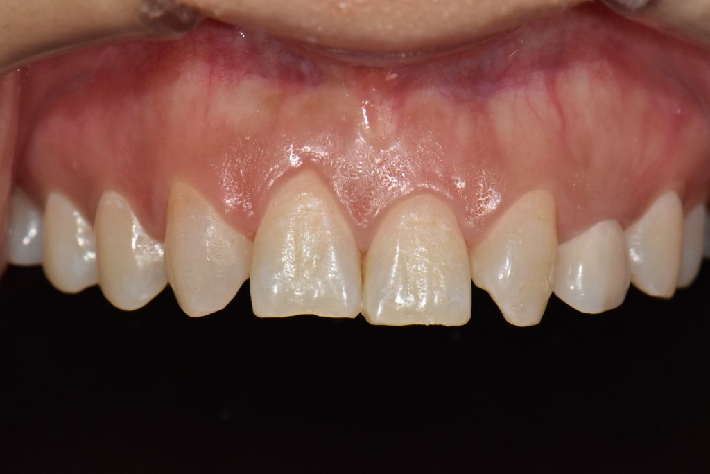 Case 03 — before treatment
